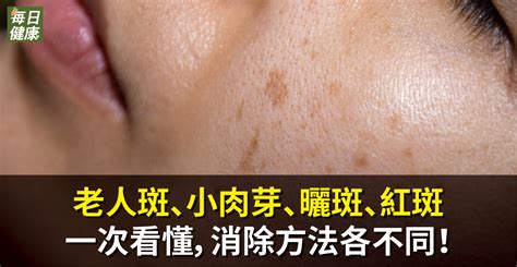 脖子長斑點|老人斑、曬斑、小肉芽、紅斑怎麼去除？皮膚科醫師1。